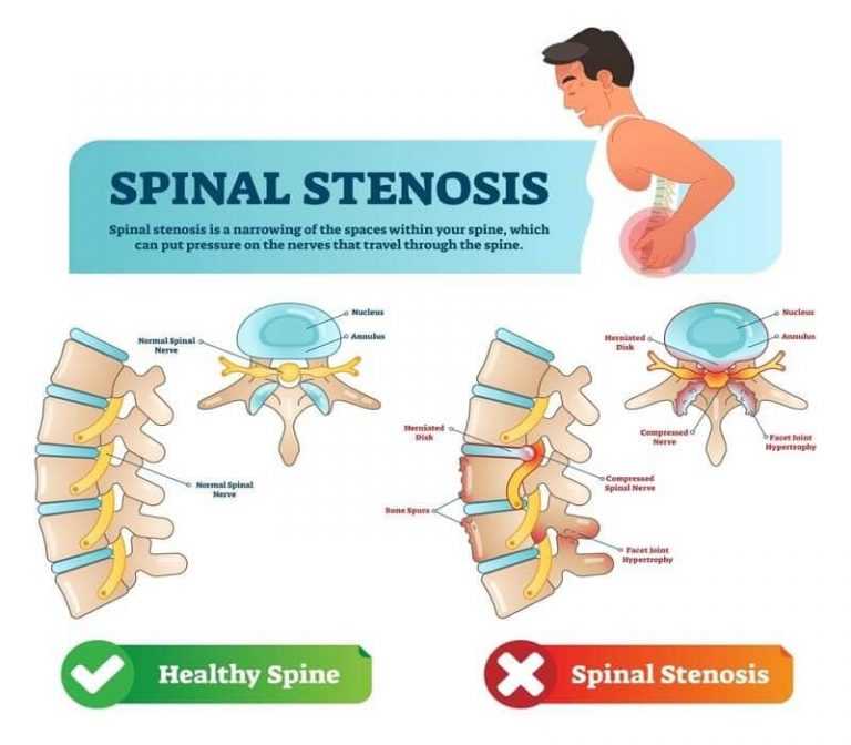 About Spinal Stenosis