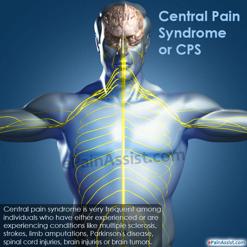 Central Pain Syndrome or CPS: Treatment, Symptoms, Causes, Epidemiology