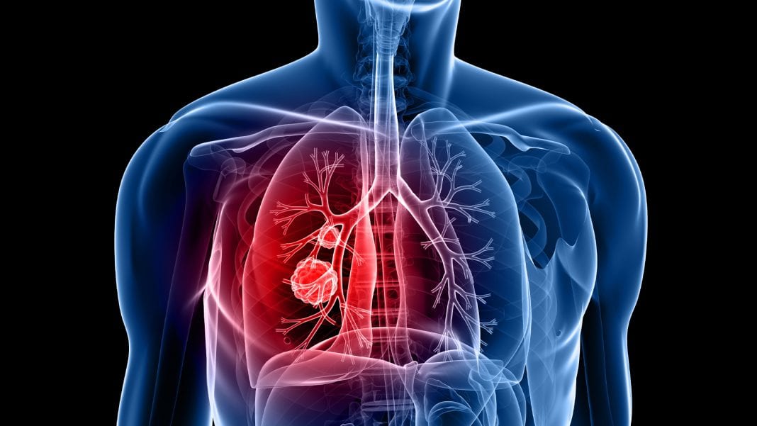 COPD: n overview of progressive lung disease
