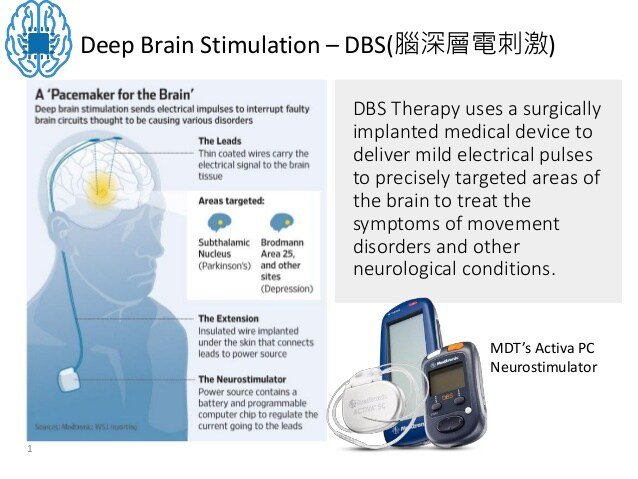 DBS &  Retinal Implant Market Analysis