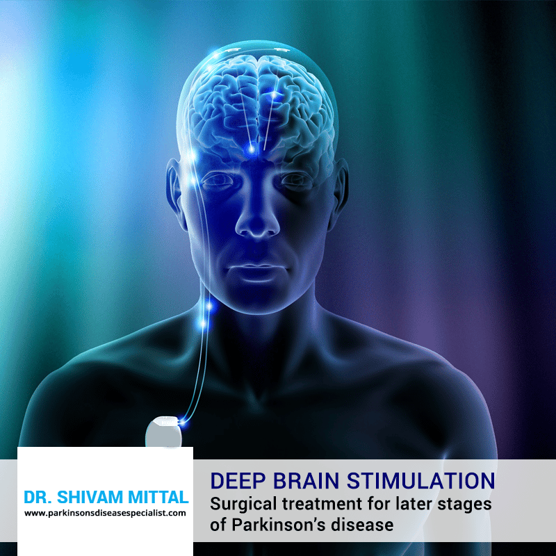 Deep Brain Stimulation is indicated for the patients who have motor ...