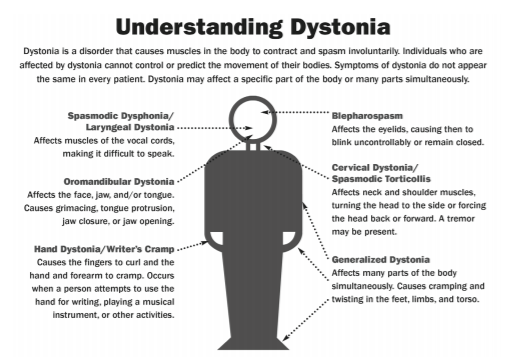 Dystonia and SD  National Spasmodic Dysphonia Association