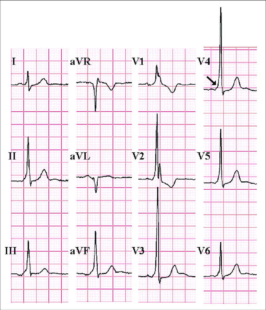 ECG shows type A Wolff