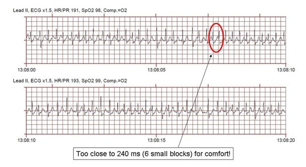 ECG Solution: The path (more) traveled