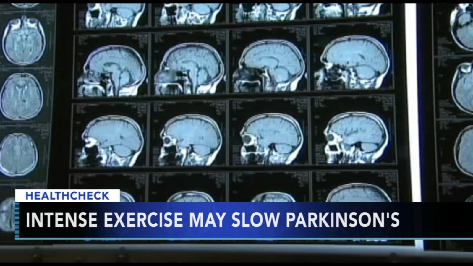 Exercise may slow progression of Parkinson