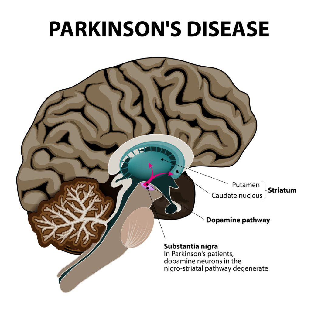Getting a VA Disability Rating for Parkinson