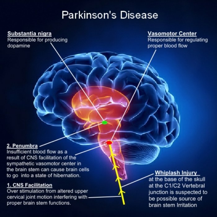 How To Cure and What To Avoid in Parkinsonâs Disease ...