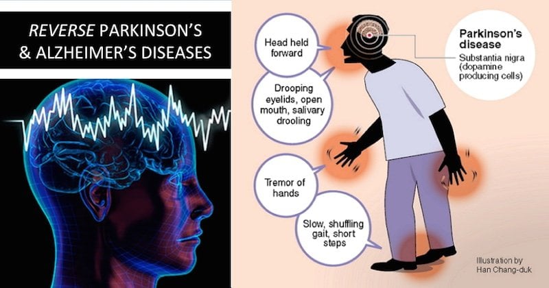 How To Naturally Reverse The Symptoms Of Parkinson