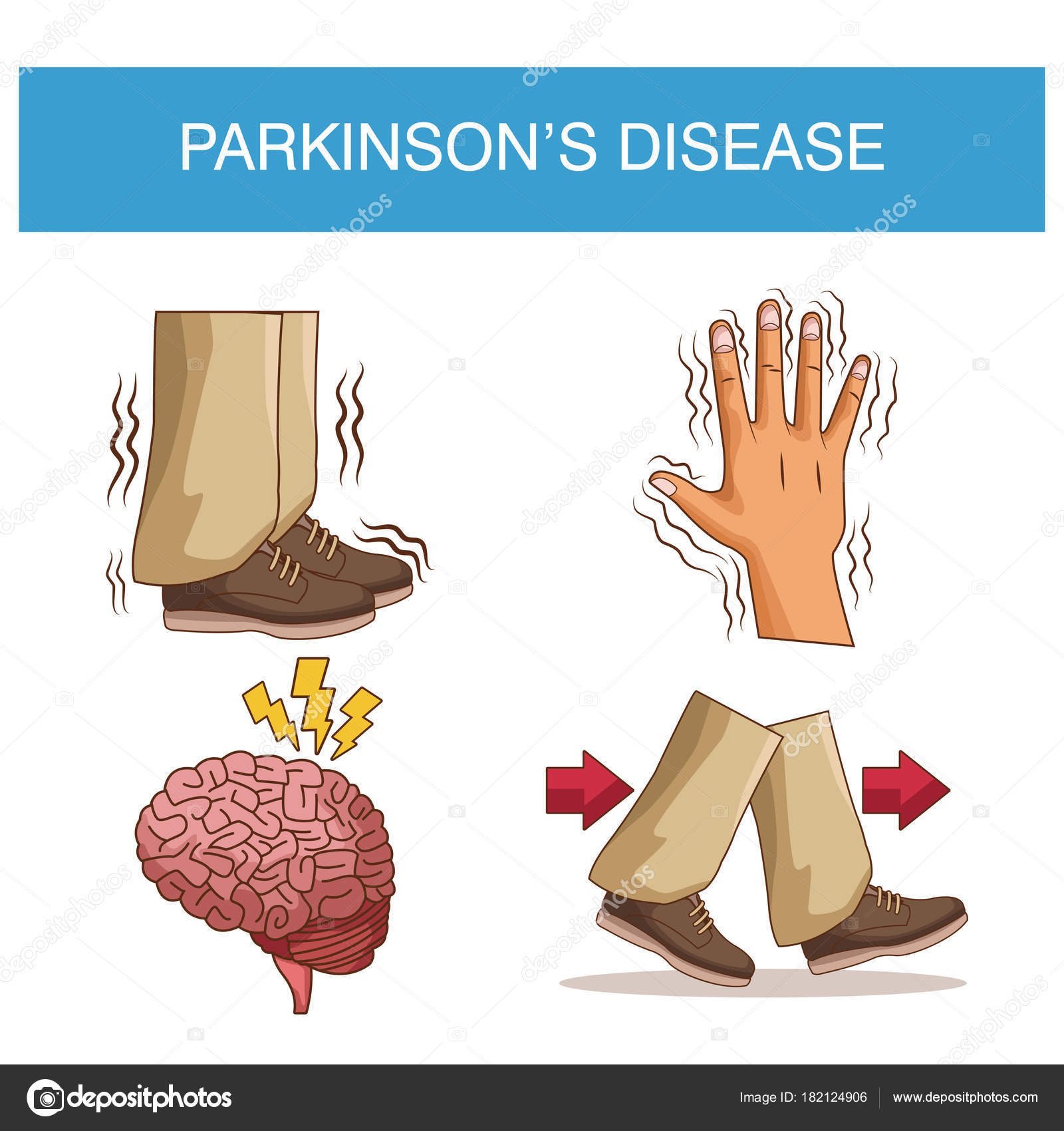 Infografía de enfermedad de Parkinson  Vector de stock © jemastock ...