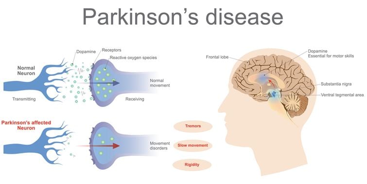 Intense Connection Between Metal Exposure And Parkinsonâs ...