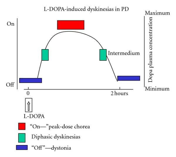 Levodopa side effects: Dyskinesia