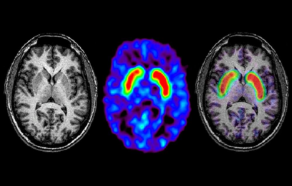 MRI in Parkinson Disease: Expanding Usability for Better Diagnostics