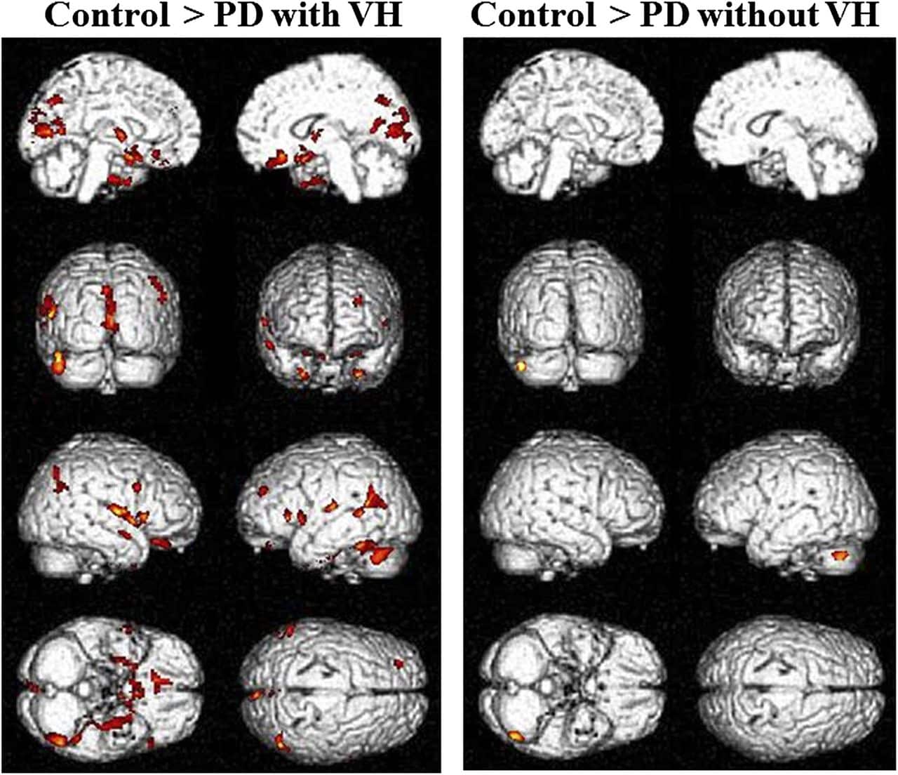 Neuroanatomical substrates of visual hallucinations in patients with ...