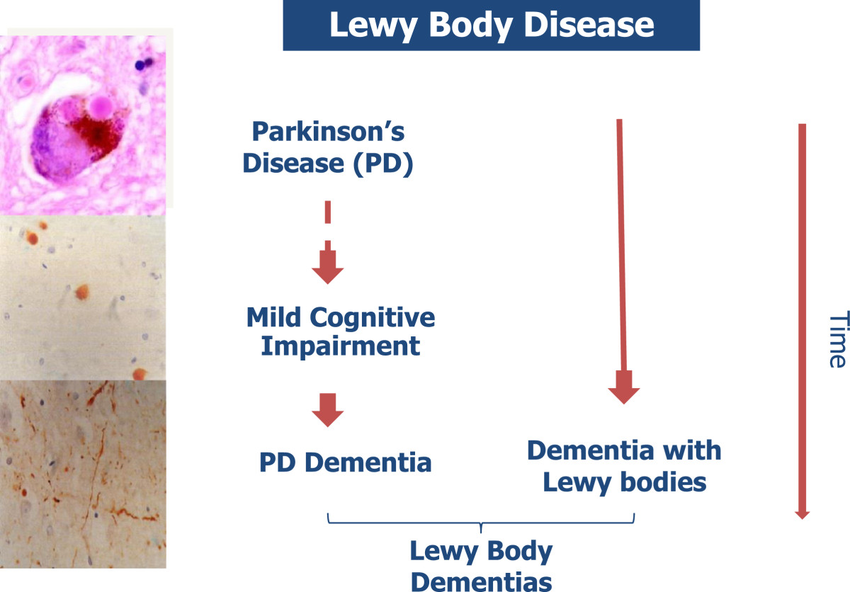 Nomenclature of Lewy body diseases. Parkinsons disease ...