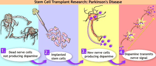Parkinson Disease And Stem Cells