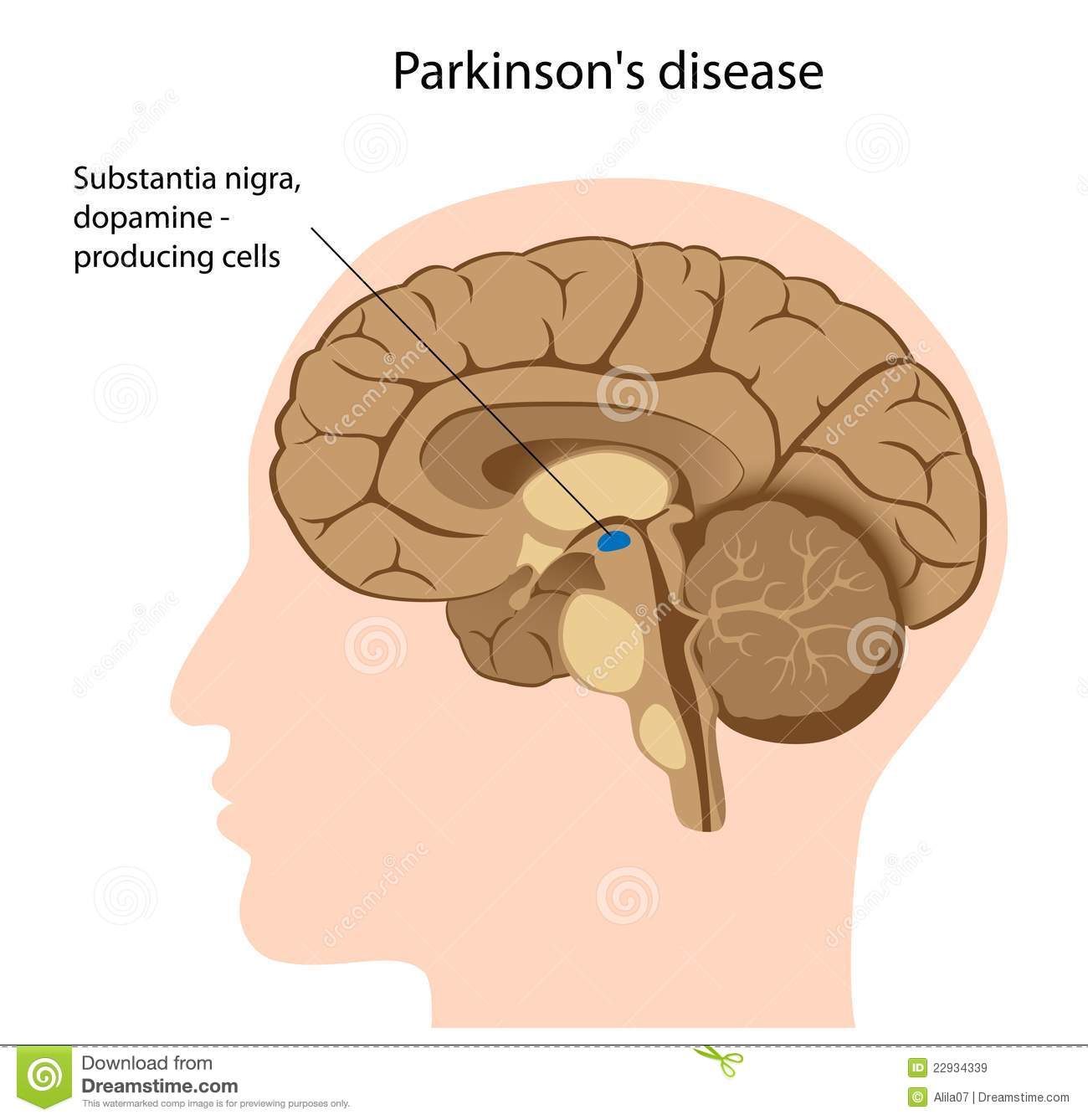Parkinson s disease stock vector. Illustration of human