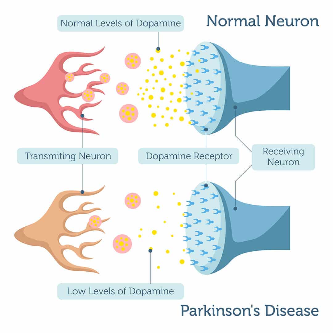 Parkinsonâs Disease DNA Test â DNA Access Lab