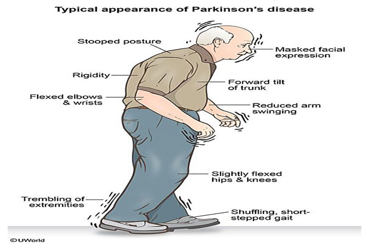 Parkinsons Disease  BLOGS