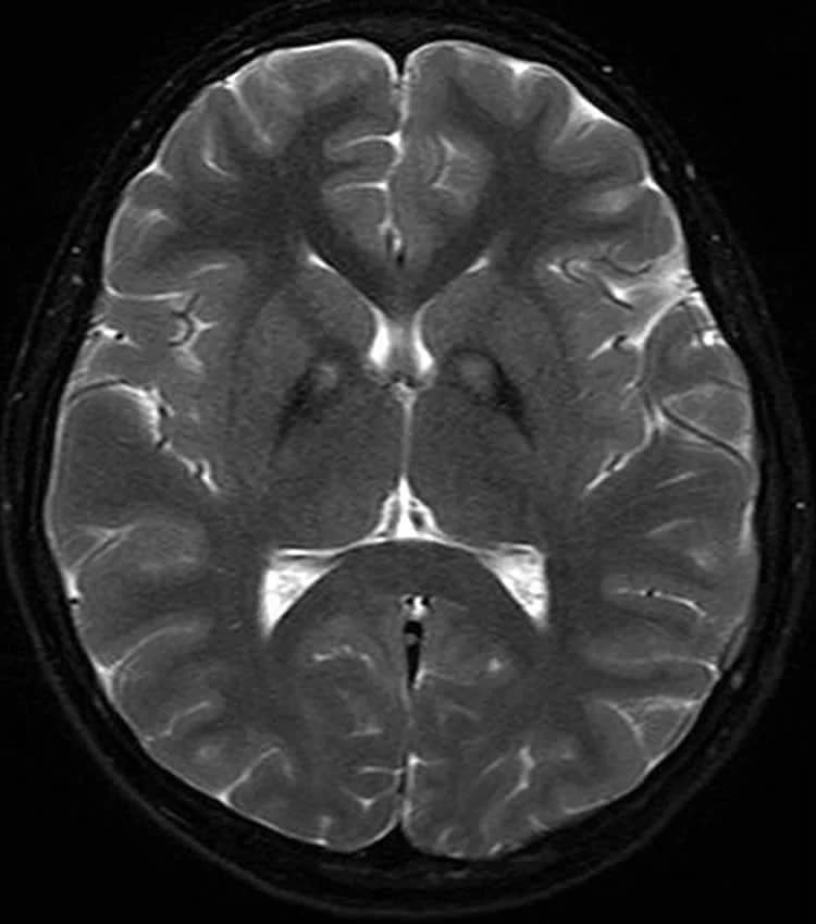Parkinsons Disease Brain Scan
