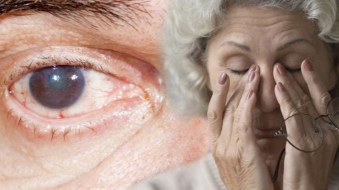 Parkinsons disease: Colour vision, dry eyes and double ...