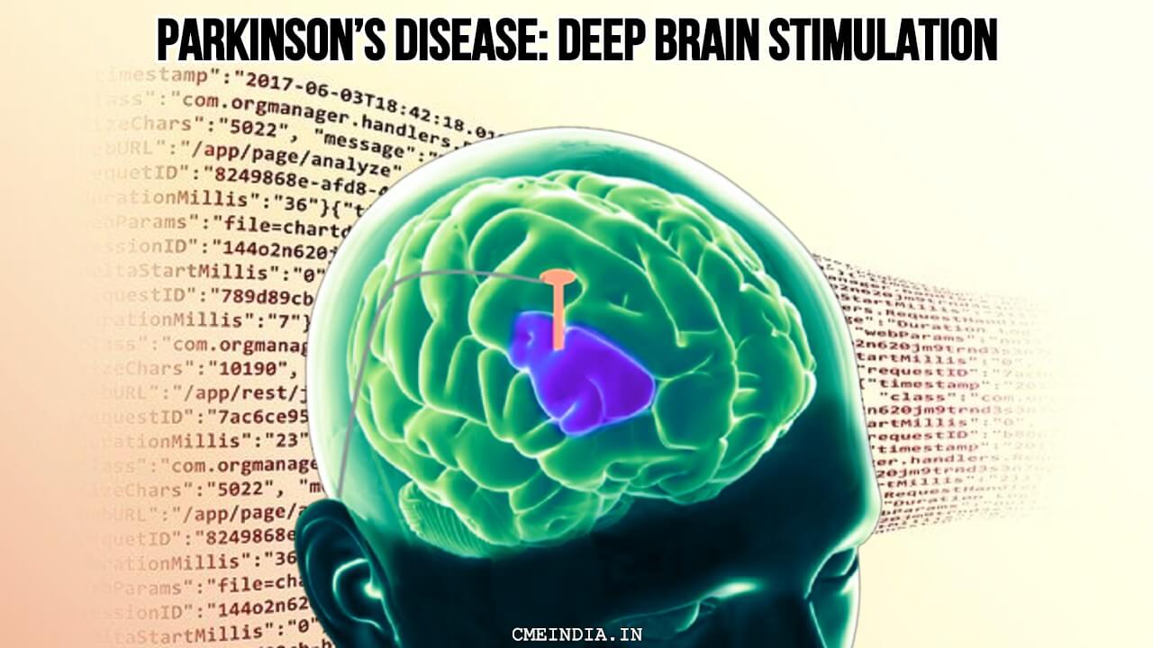 Parkinsons disease: Deep Brain Stimulation