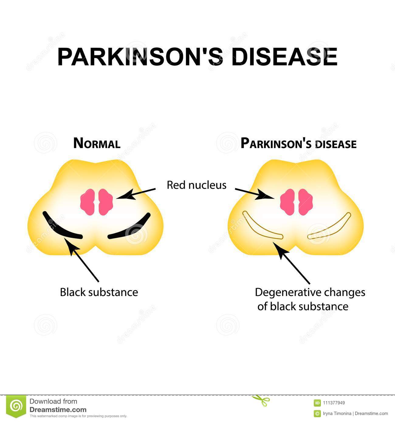 Parkinson`s Disease. Degenerative Changes In The Brain Are A Black ...