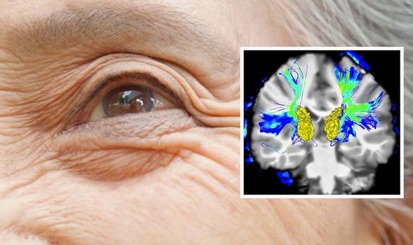 Parkinsons disease: Signs include dry eyes, double vision ...