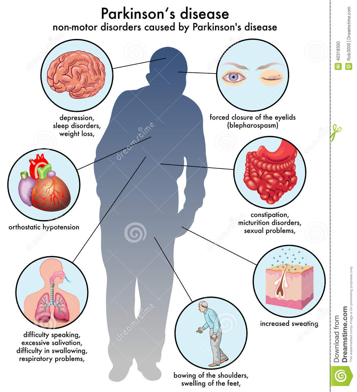 Parkinsons disease stock vector. Illustration of ...