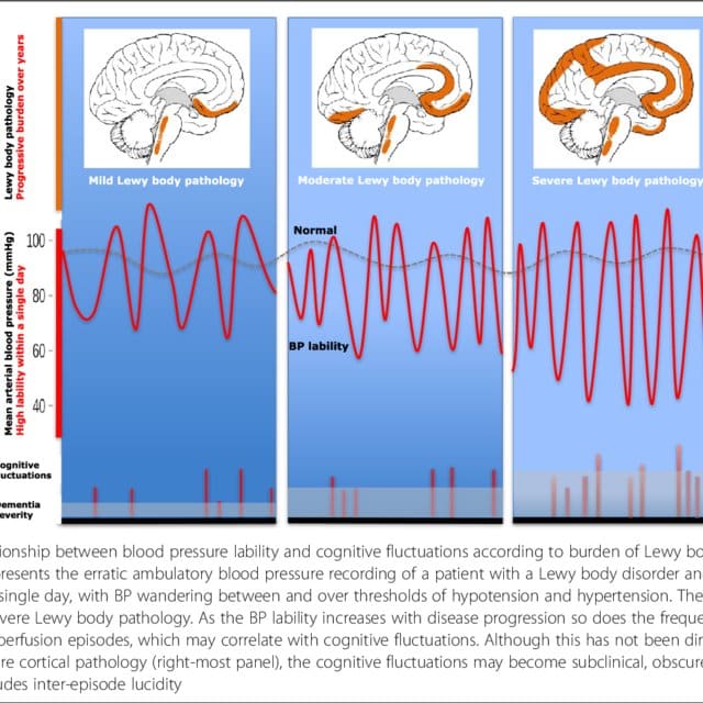 (PDF) Cognitive fluctuations in Parkinsons disease dementia: blood ...