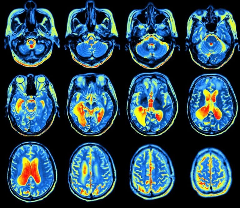 PET Scan Distinguishes Juvenile HD From Parkinsonâs in Case Study