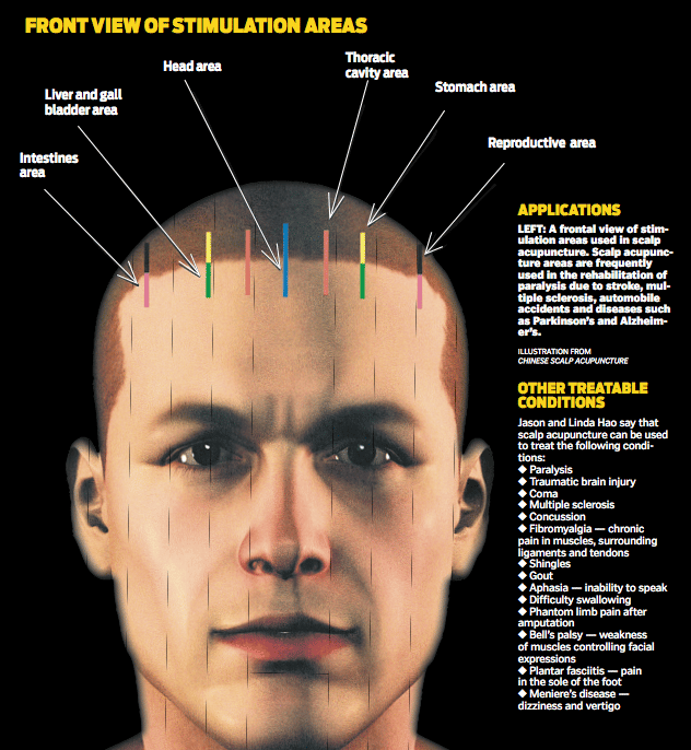 scalp acupuncture points for aphasia
