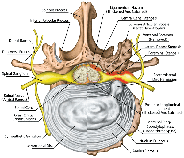 Spinal Stenosis Information