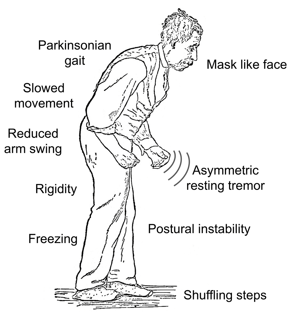 Stage Four Parkinson