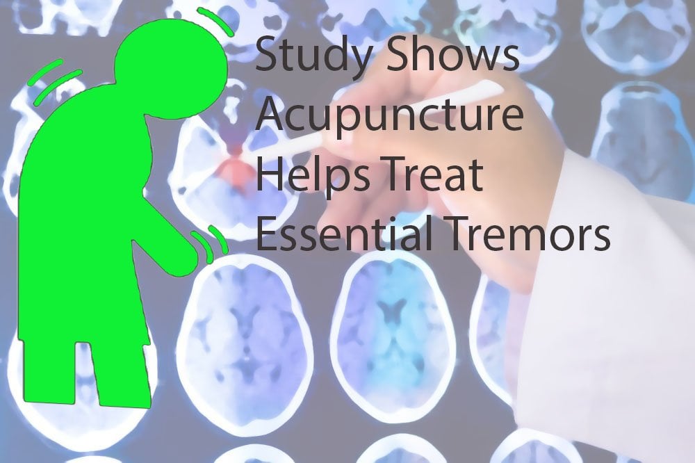 Study Shows Acupuncture Helps Treat Essential Tremors