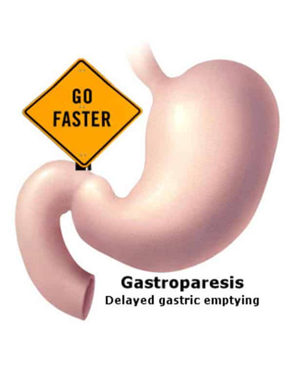 Suffering from Gastroparesis? Visit CLASS, Chennai