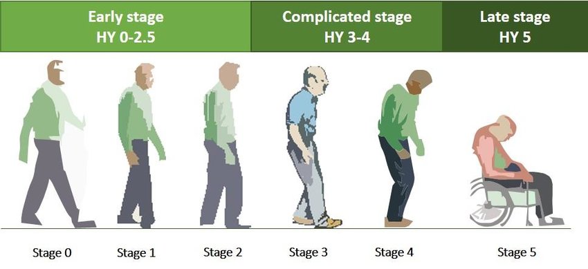 The Hoehn &  Yahr scale classifying different stages of ...