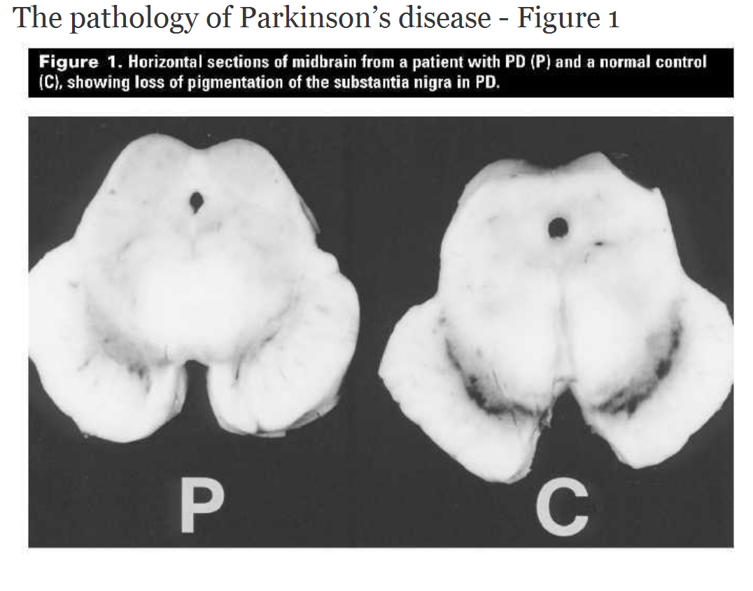 The pathology of Parkinsons disease