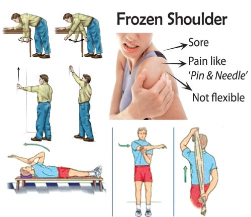 Unlocking the Frozen Shoulder