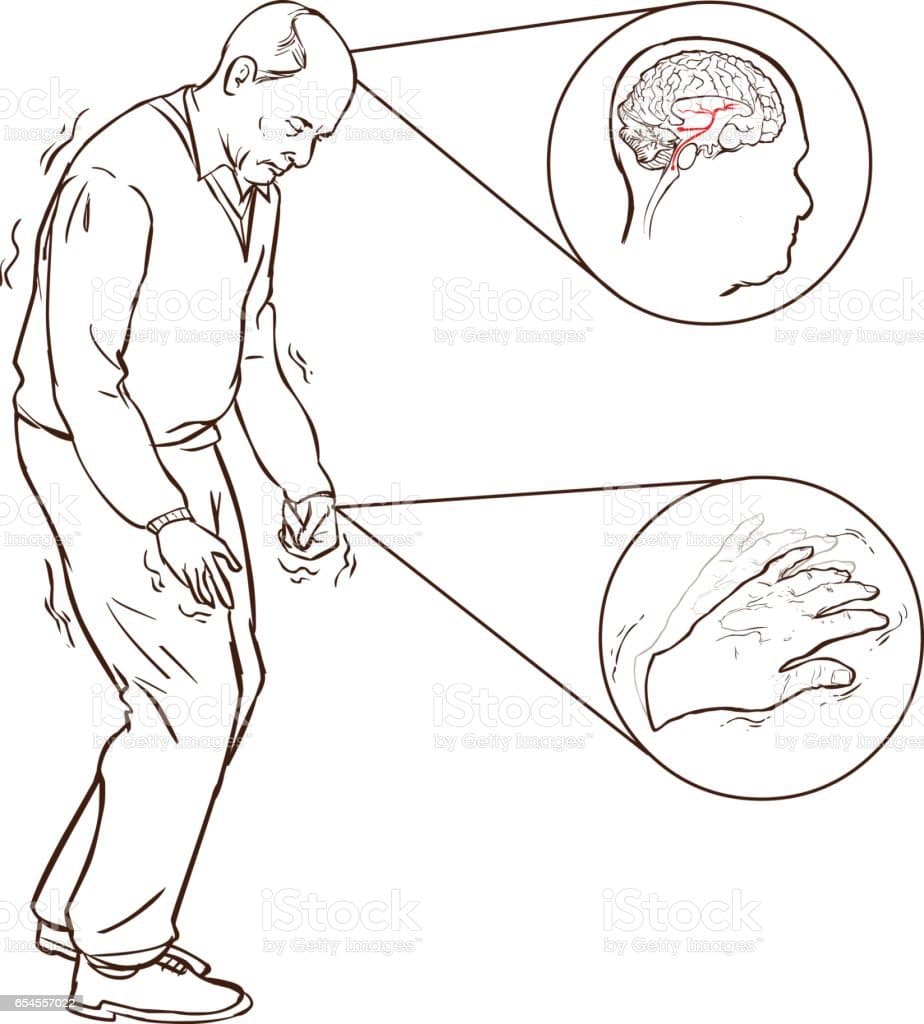Vector Illustration Of Aold Man With Parkinson Symptoms Difficult ...