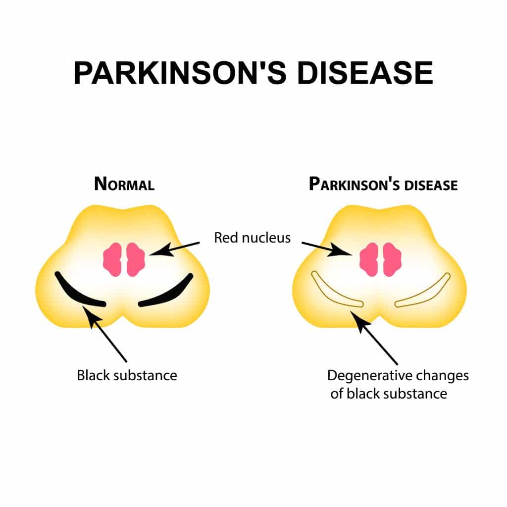 What Are The Best Essential Oils And Recipes To Manage Parkinsonâs ...