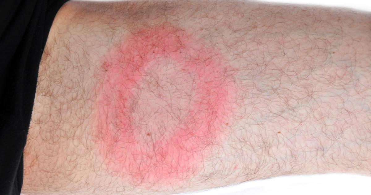 What happens if Lyme disease goes untreated?