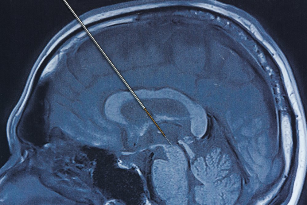 What Is Deep Brain Stimulation, and Why Does It Work for ...