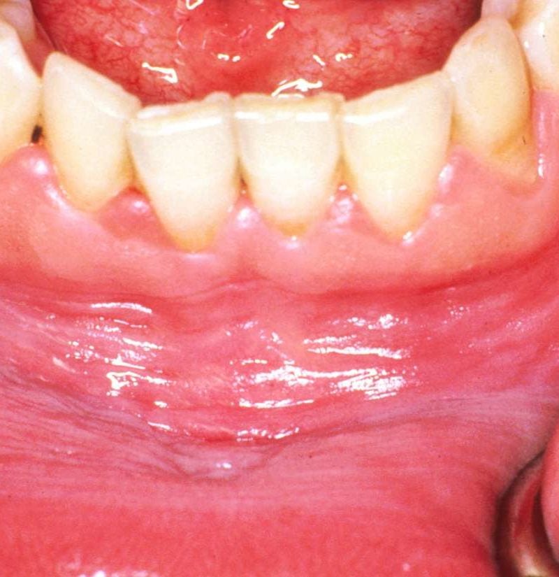 White gums: Causes, symptoms, and how to get rid of them